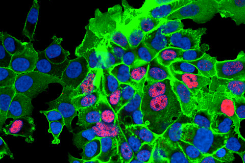 The image shows prostate cancer cells in which KLF4 and the CD44 protein on the cell membrane are stained. Image: Kirsi Kainulainen